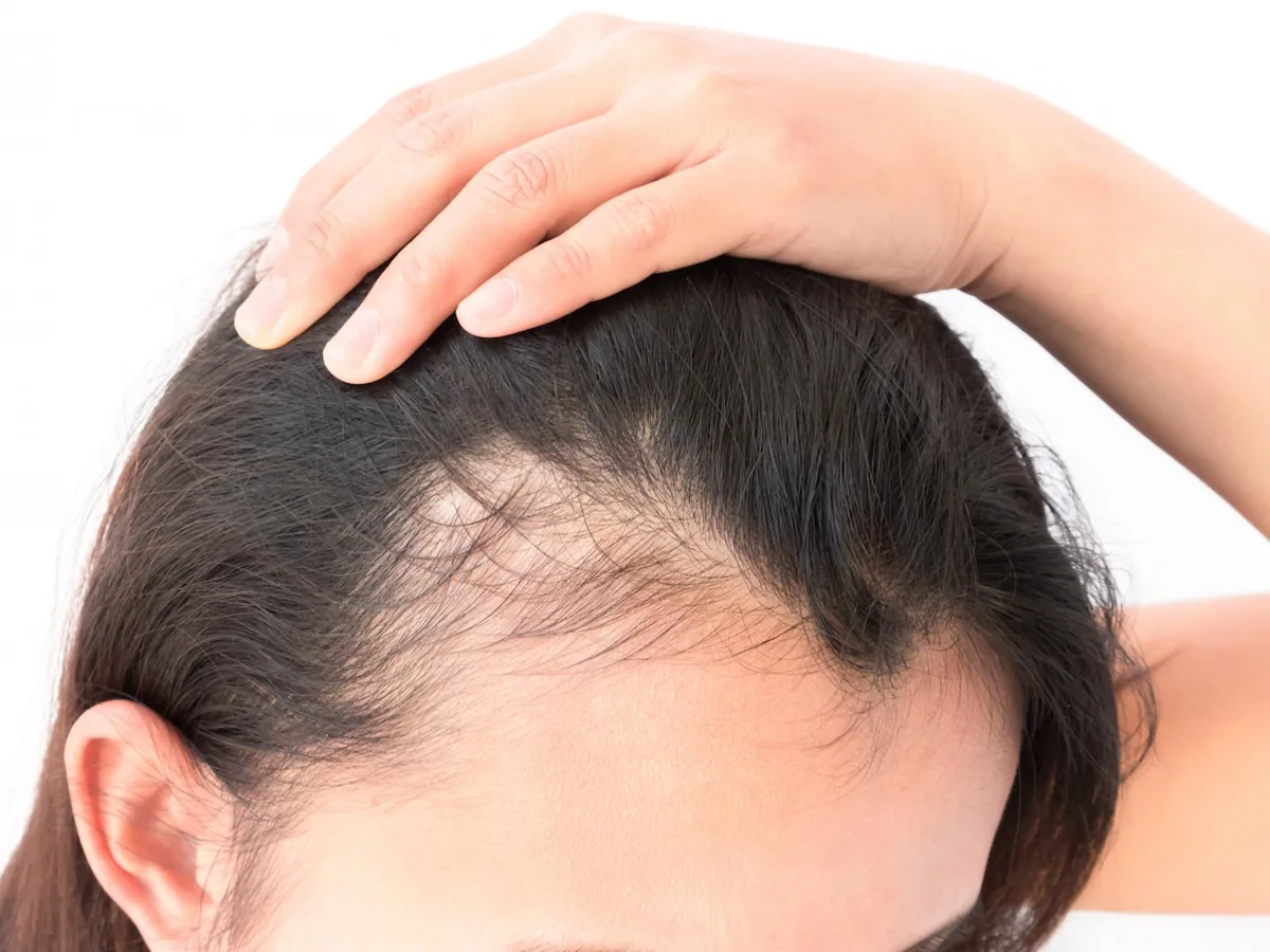 PRP (PRP) - thérapie à Haïfa et Krayot pour la santé des cheveux ( טיפול פרפ )