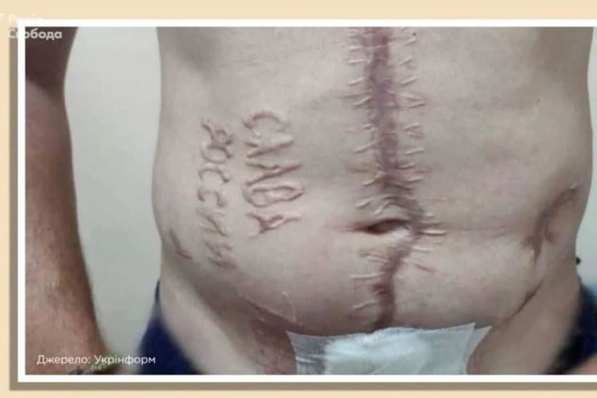 Пока путина приглашают в «Совет мира», названы российские хирурги, причастные к выжиганию «Слава России» на теле украинского военнопленного